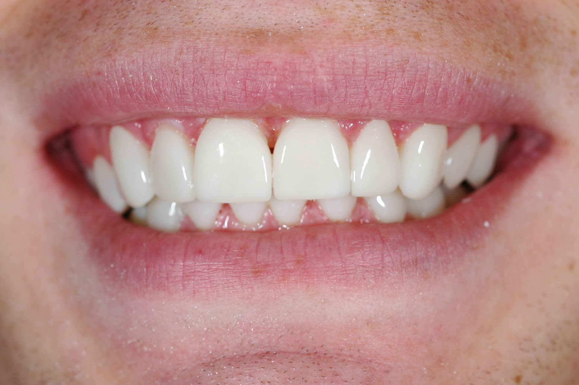 Oplossing diastema of spleetjes tussen de tanden