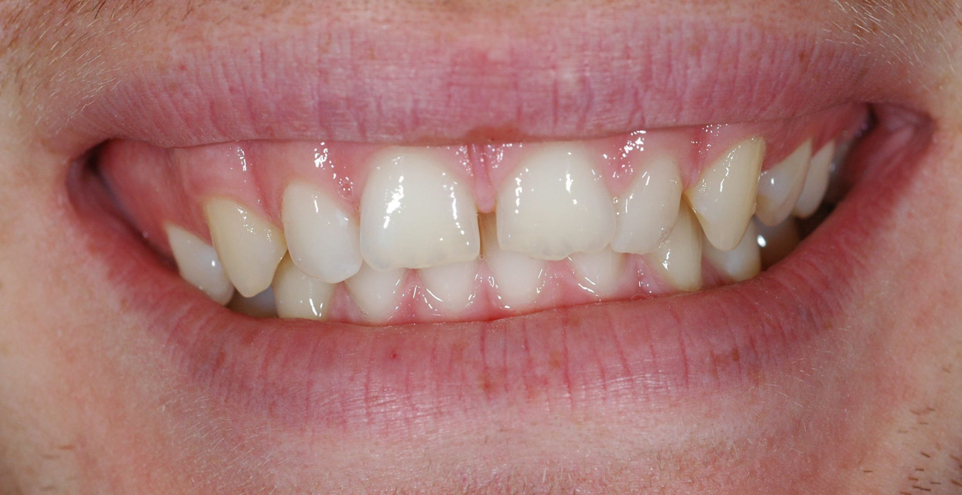 Diastema of spleetjes tussen de tanden
