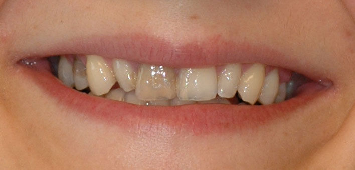 tetracycline verkleuring tanden