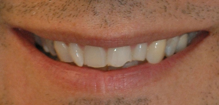 facings als oplossing voor afgebroken tand