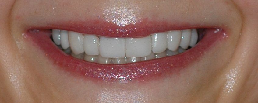 oplossing tetracycline verkleuring tanden