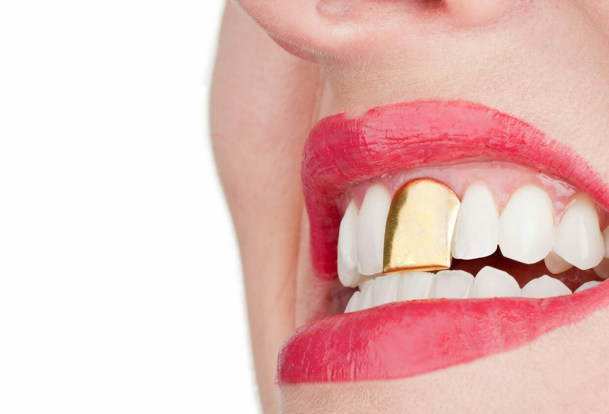 Een gouden tand: nog van deze tijd?